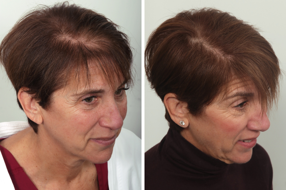 Female Hair Transplant